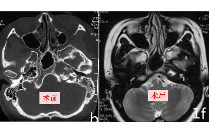 内镜经鼻岩尖胆固醇肉芽肿切除术