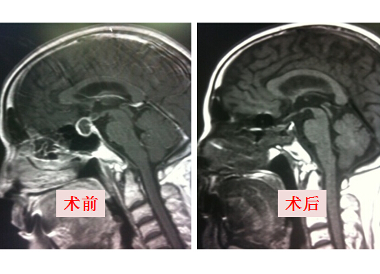 内镜经鼻蝶入路手术治疗垂体脓肿