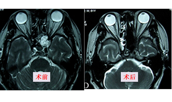 内镜经鼻低温等离子射频辅助颅底黏液腺癌切除术